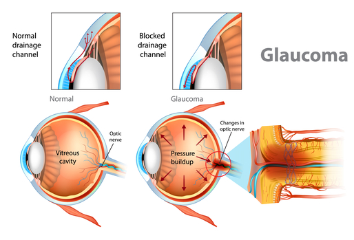 Glaucoma Berwyn Glaucoma Surgery Procedure